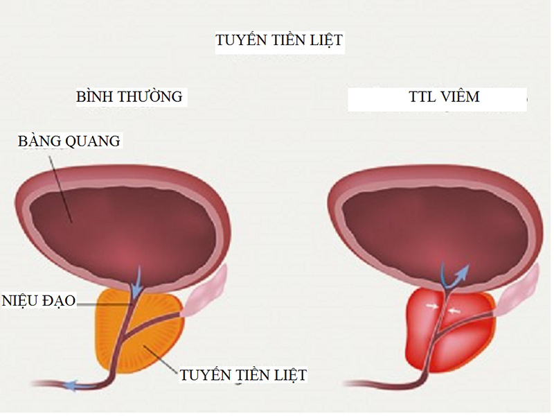 viem-tuyen-tien-liet-cap-tinh-nguyen-nhan-trieu-chung-va-chan-doan